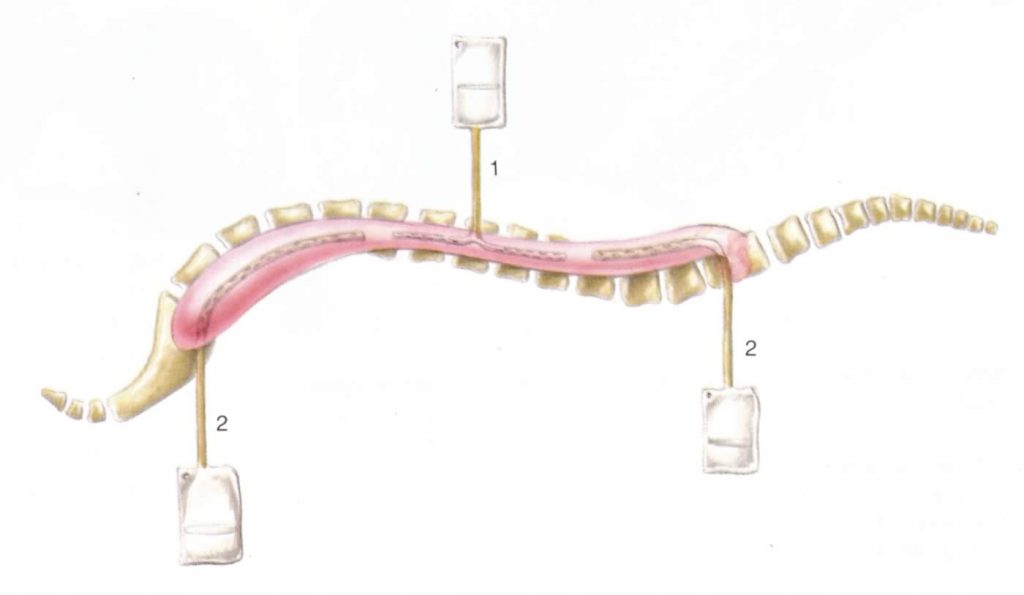 Dirk Fabian - Georg Thieme - Orthopaedische Operationslehre - Vol10 Spondylitis - 07